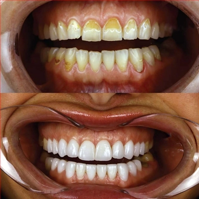 Veneers at Incidis International Dental Clinic