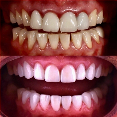 Veneers at Incidis International Dental Clinic