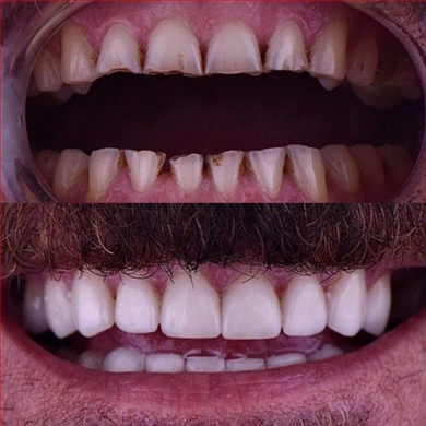Crowns at Incidis International Dental Clinic