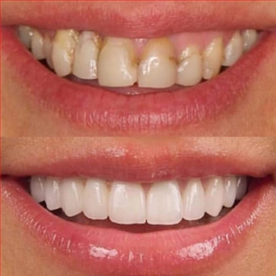 Hollywood Smile at Incidis International Dental Clinic