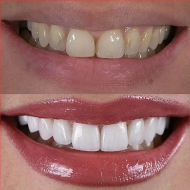 Hollywood Smile at Incidis International Dental Clinic
