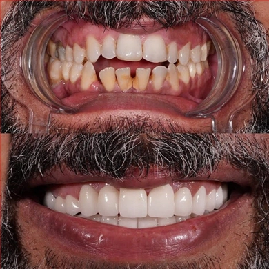 Crowns at Incidis International Dental Clinic