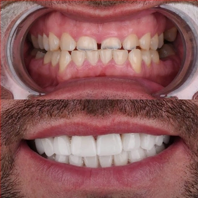 Crowns at Incidis International Dental Clinic