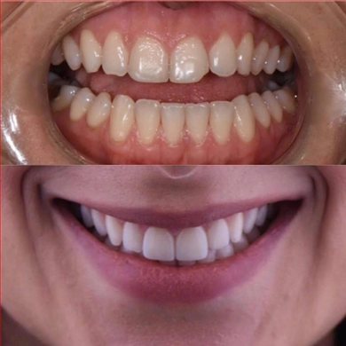 Hollywood Smile at Incidis International Dental Clinic