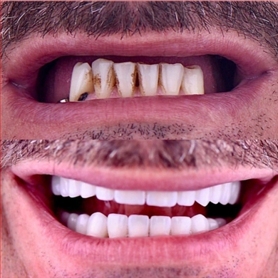 All-on-4 at Incidis International Dental Clinic