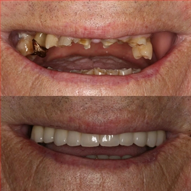 All-on-4 at Incidis International Dental Clinic