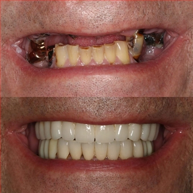 All-on-4 at Incidis International Dental Clinic