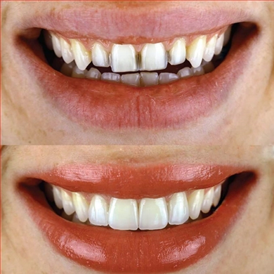 Hollywood Smile at Incidis International Dental Clinic