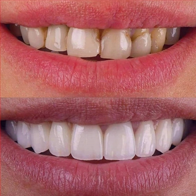 Veneers at Incidis International Dental Clinic