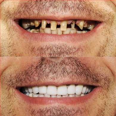 Crowns at Incidis International Dental Clinic