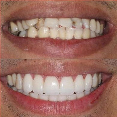 Crowns at Incidis International Dental Clinic