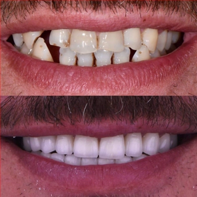 All-on-4 at Incidis International Dental Clinic