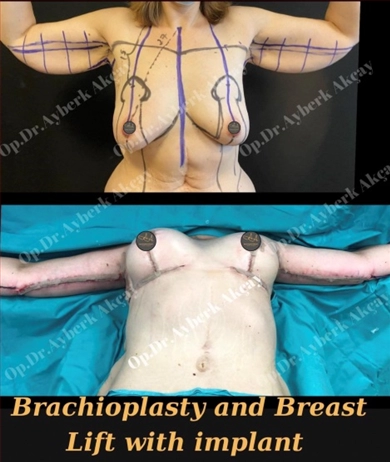 Arm Lift at Dr. Ayberk Akcay Clinic