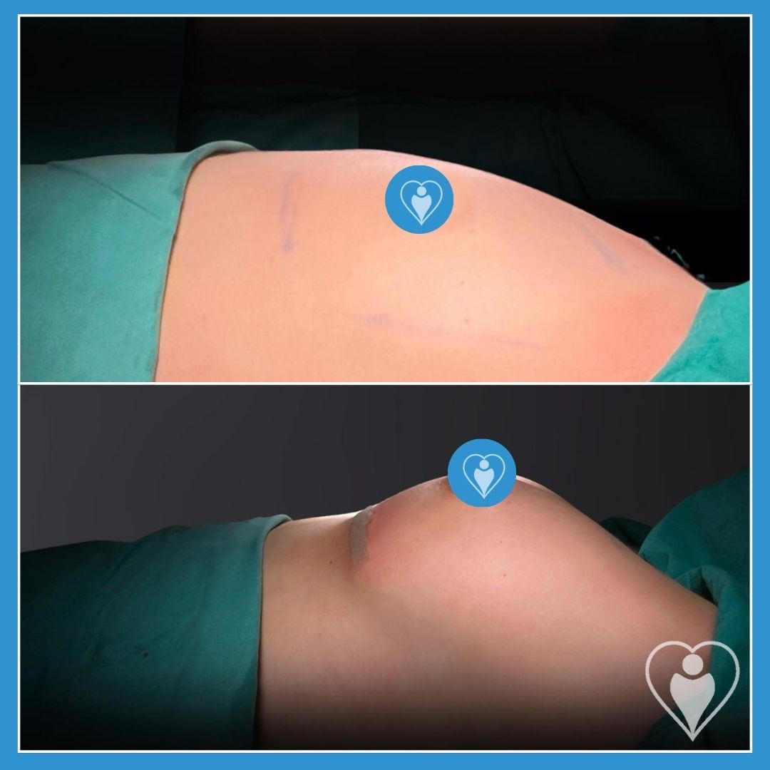 Breast implants, before and after, Luna Clinic Turkey