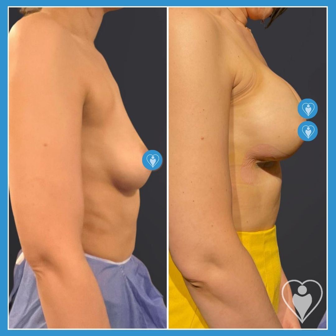 Breast implants, before and after, Luna Clinic Turkey