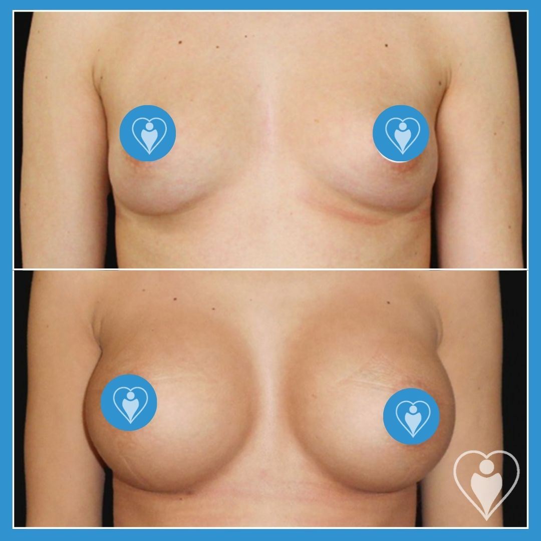 Breast implants, before and after, Luna Clinic Turkey