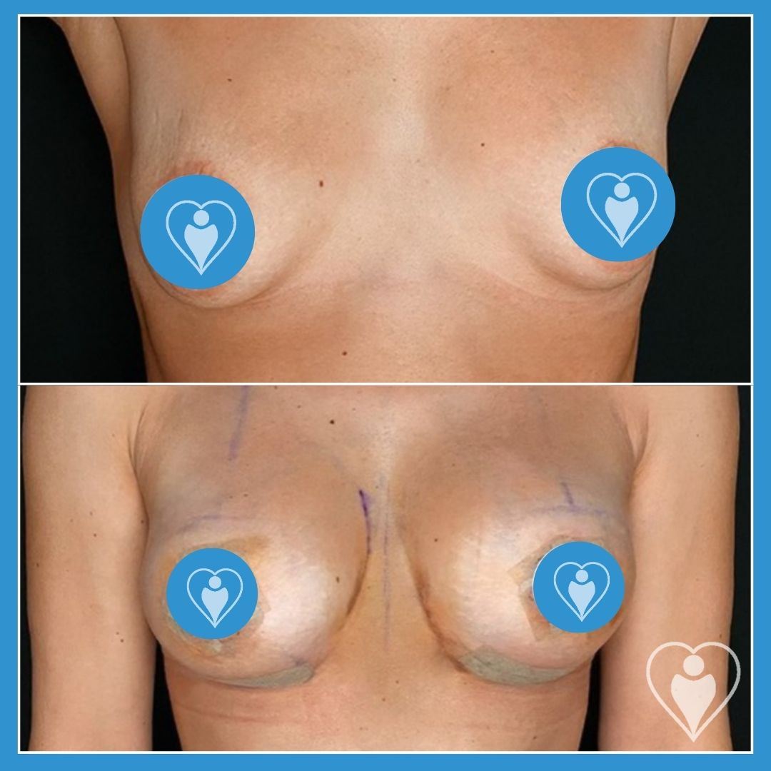 Breast implants, before and after, Luna Clinic Turkey