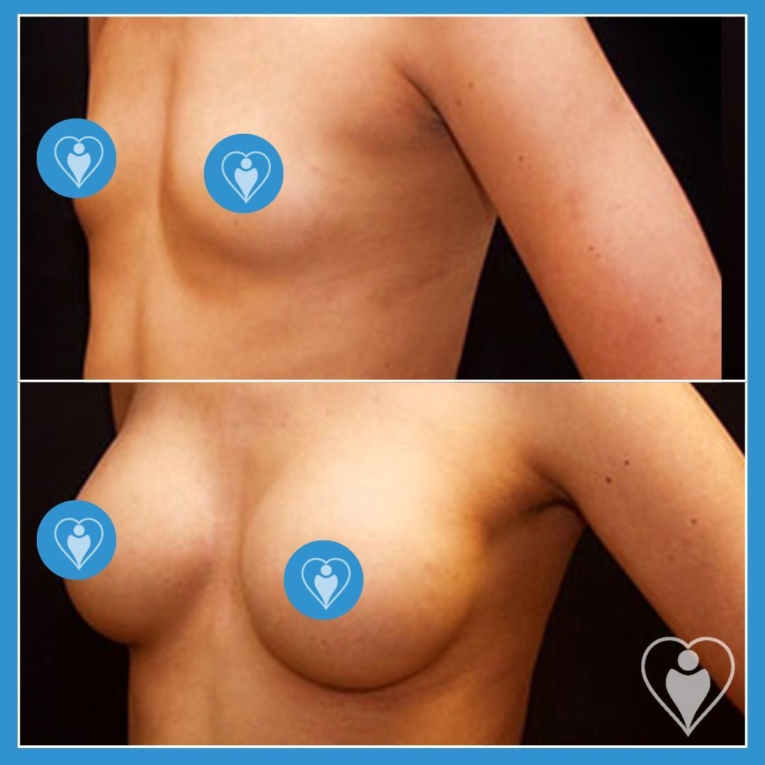 Breast implants, before and after, Istanbul European Clinic