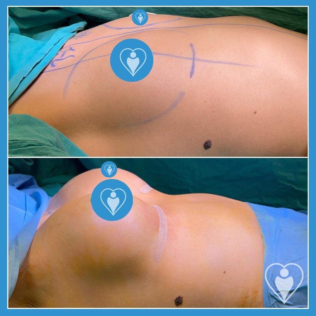 Breast implants, before and after, Luna Clinic Turkey