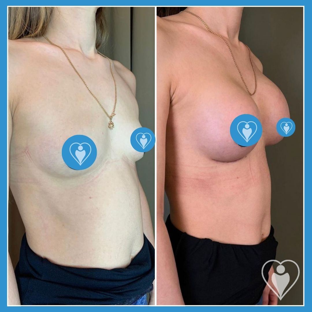 Breast implants, before and after, Luna Clinic Turkey