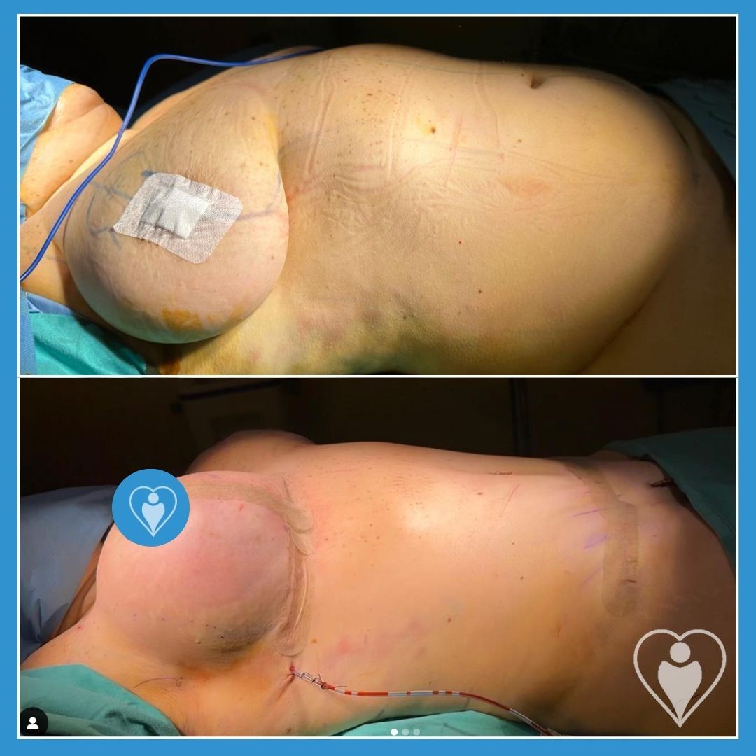 Breast lift, before and after, Luna Clinic Turkey