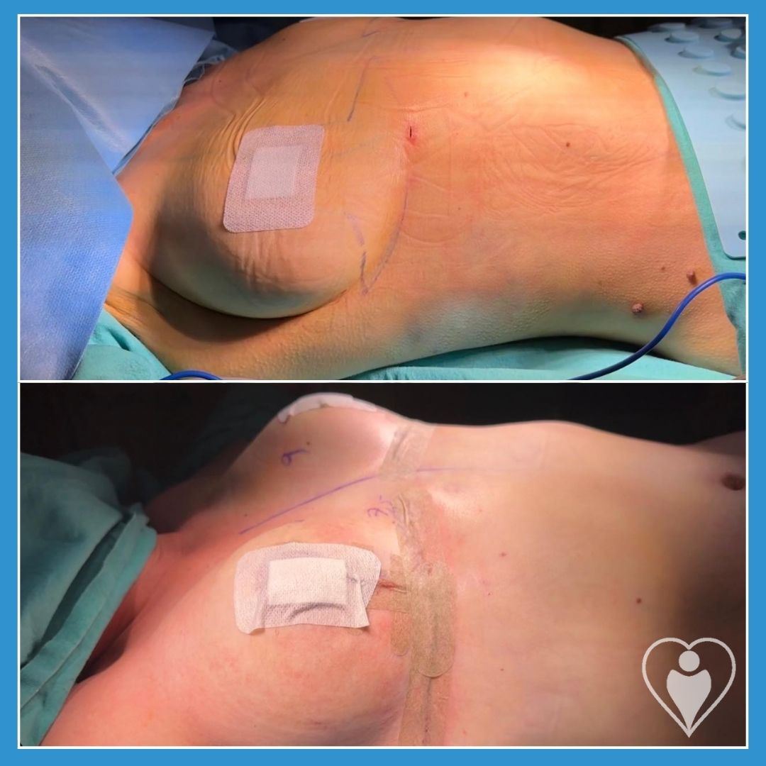 Breast lift, before and after, Luna Clinic Turkey