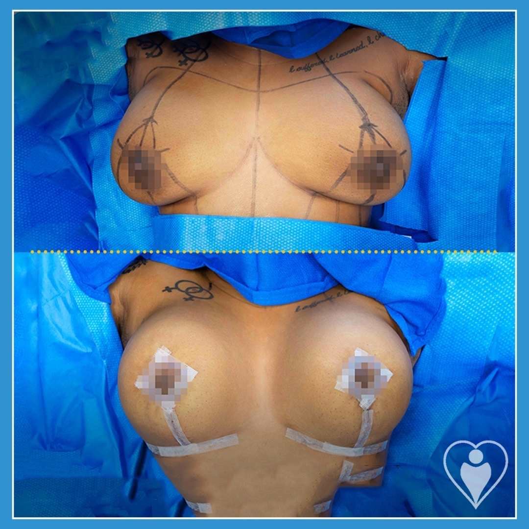 Breast implants, before and after, Luna Clinic Turkey