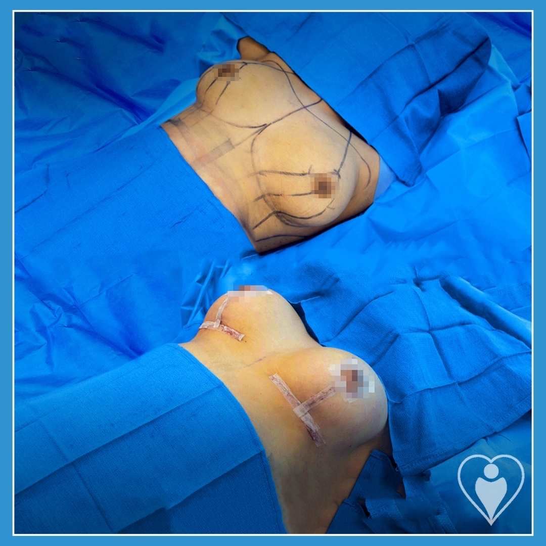 Breast implants, before and after, Luna Clinic Turkey