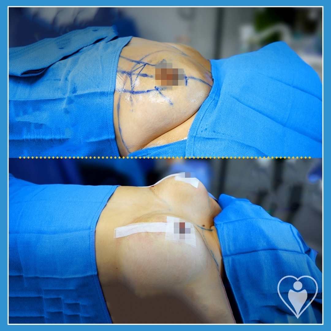 Breast implants, before and after, Luna Clinic Turkey