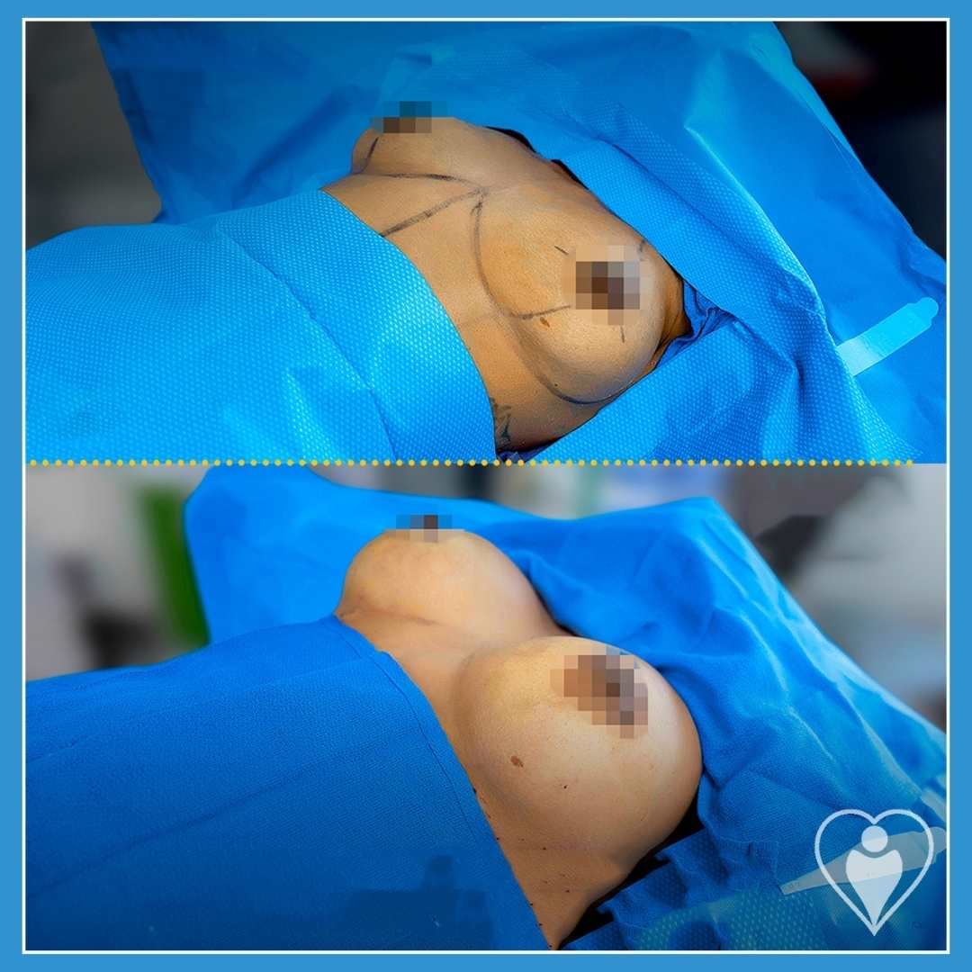 Breast implants, before and after, Luna Clinic Turkey