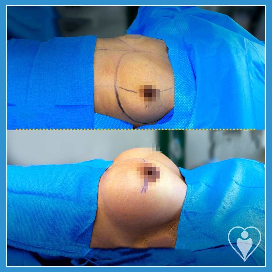 Breast implants, before and after, Luna Clinic Turkey