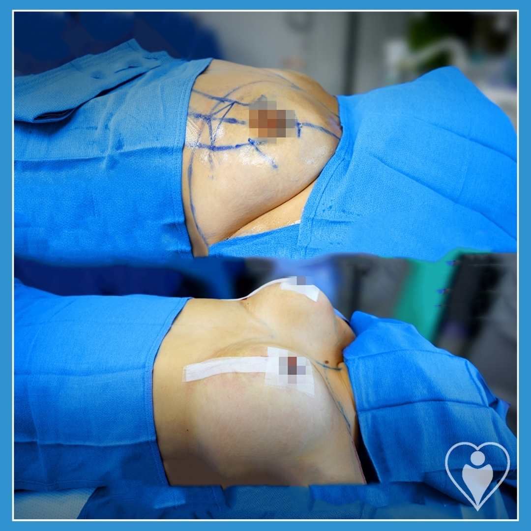 Breast implants, before and after, Luna Clinic Turkey
