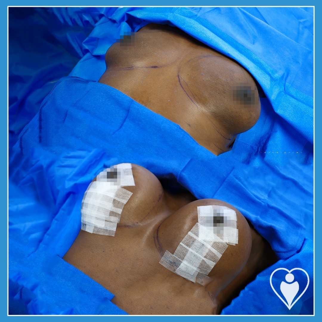 Breast implants, before and after, Luna Clinic Turkey