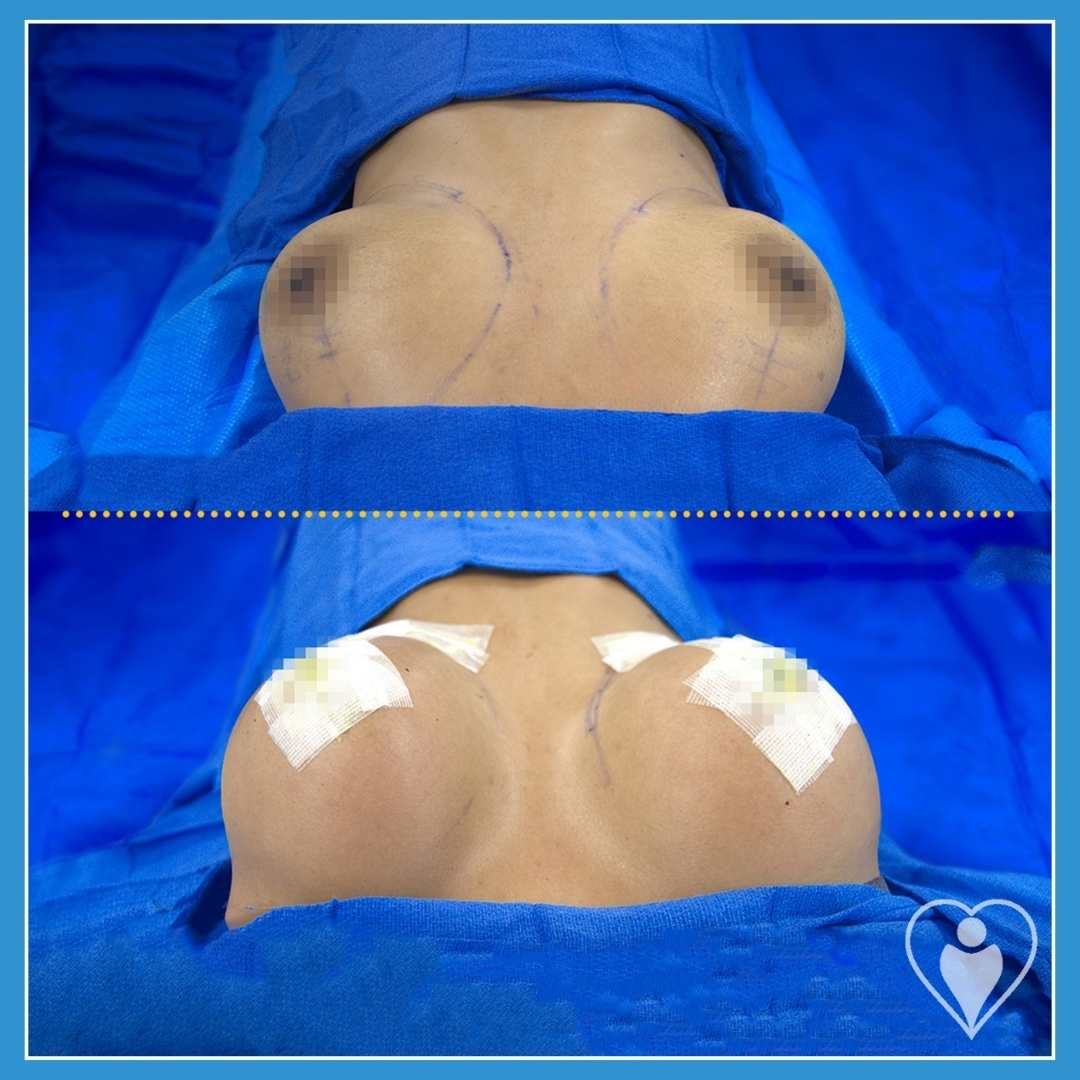 Breast implants, before and after, Luna Clinic Turkey