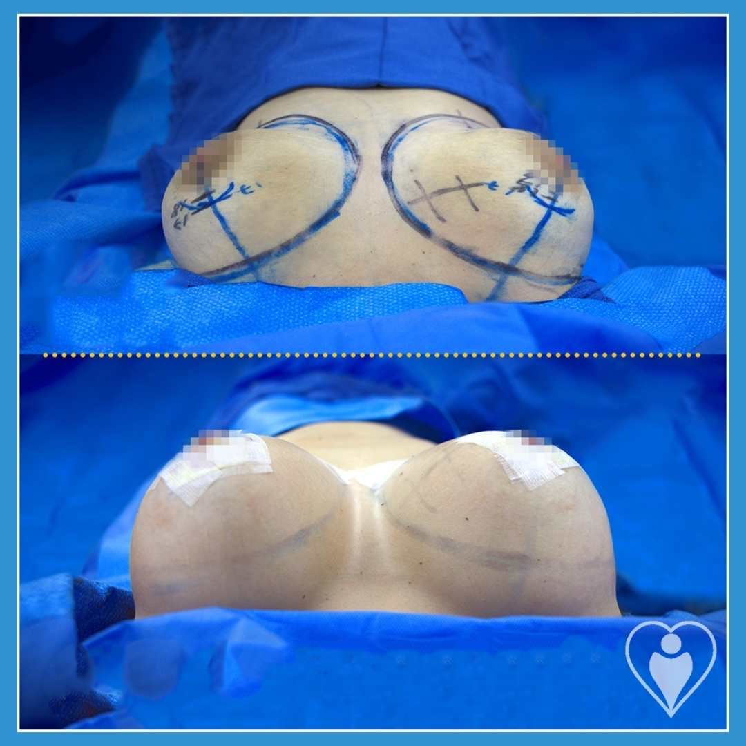 Breast implants, before and after, Luna Clinic Turkey