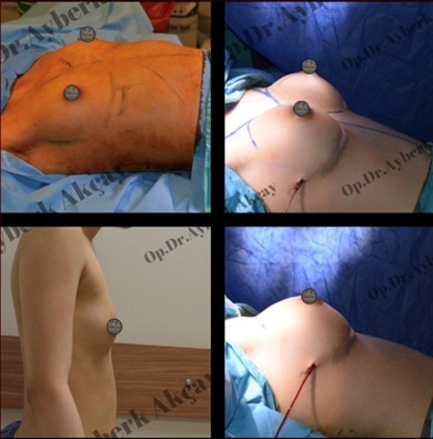 Breast Implants at Dr. Ayberk Akcay Clinic