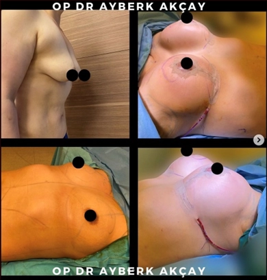 Breast Implants at Dr. Ayberk Akcay Clinic