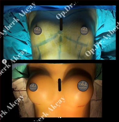 Breast Implants at Dr. Ayberk Akcay Clinic