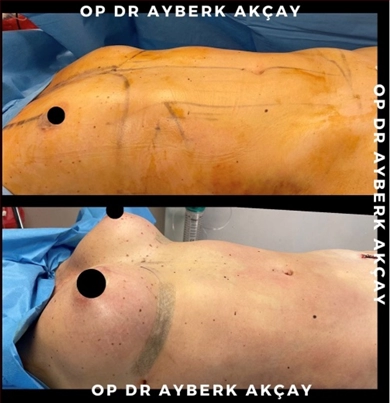 Breast Implants at Dr. Ayberk Akcay Clinic