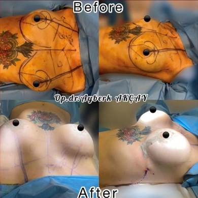 Breast Implants at Dr. Ayberk Akcay Clinic