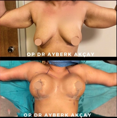 Arm Lift at Dr. Ayberk Akcay Clinic