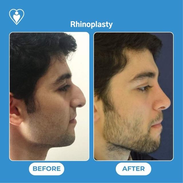 Rhinoplasty, before and after, Luna Clinic Turkey