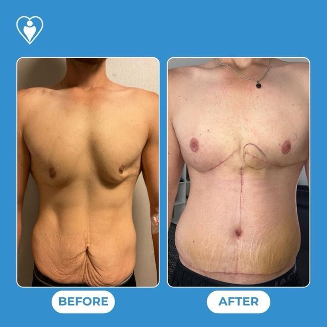 Antes y después, Abdominoplastia Flor de Lis