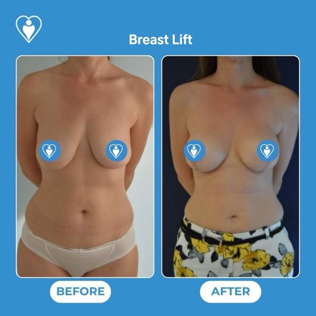 Breast lift, before and after, Luna Clinic Turkey