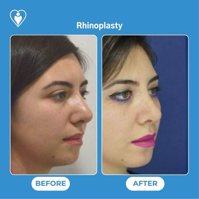 Rhinoplasty, before and after, Luna Clinic Turkey