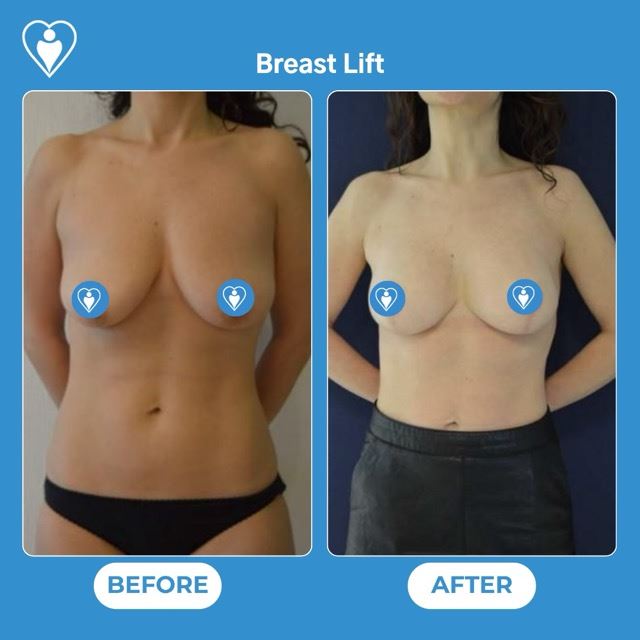 Breast lift, before and after, Luna Clinic Turkey