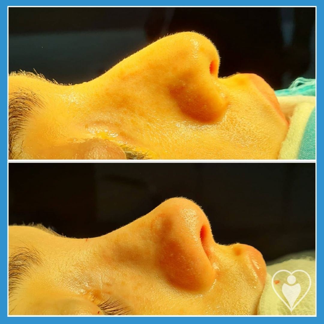 Rhinoplasty, before and after, Luna Clinic Turkey