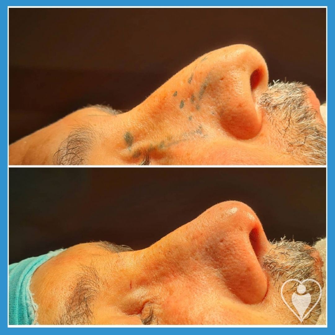 Rhinoplasty, before and after, Luna Clinic Turkey