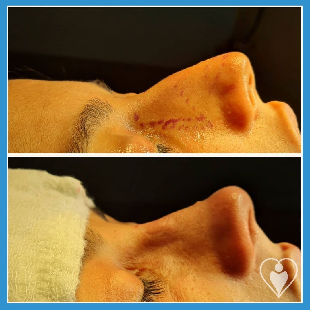 Rhinoplasty, before and after, Luna Clinic Turkey