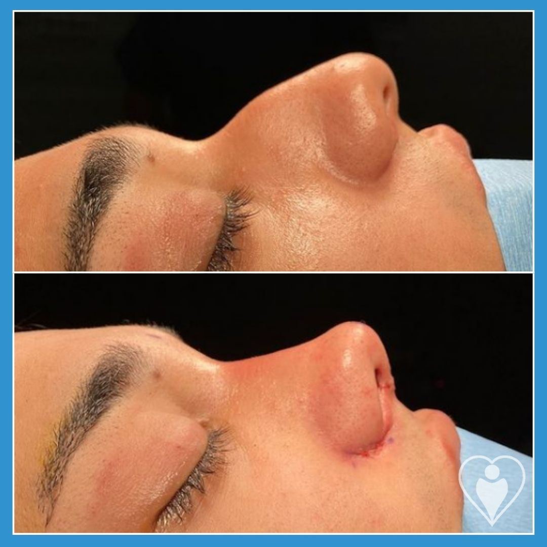 Rhinoplasty, before and after, Luna Clinic Turkey